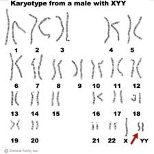 Xyy Chromosome Xyy Syndrome Is A Genetic Condition In